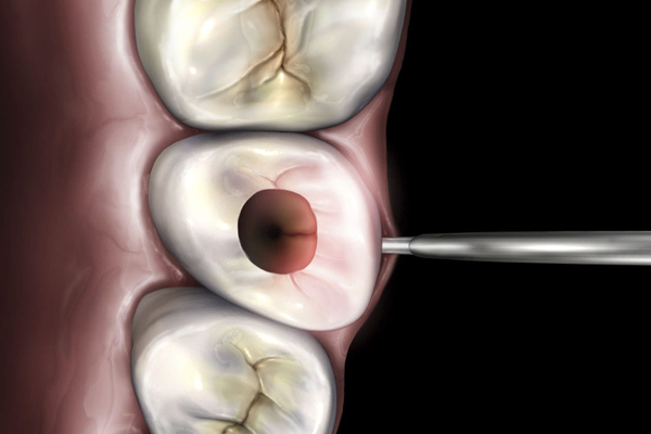 Microlux 2 Attachments - Endo Lite