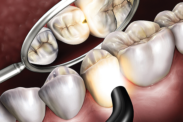 Transilluminateur Microlux 2 - Caries proximales postérieures