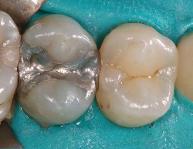 Microlux 2 Transilluminator Identifying Proximal Posterior Caries