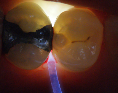 Microlux 2 Transilluminator Identifying Proximal Posterior Caries