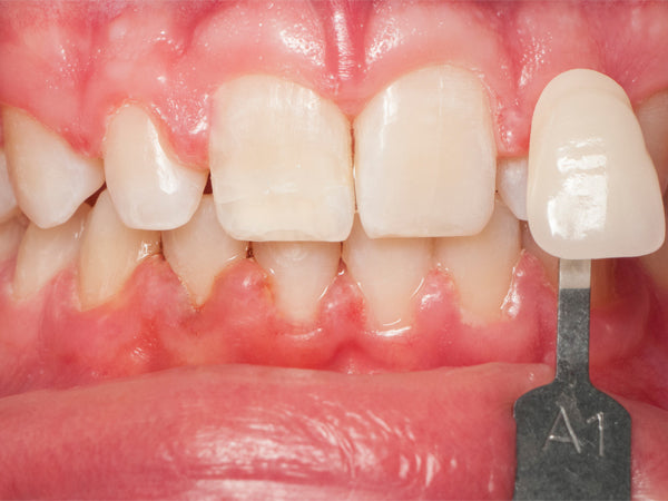 Teeth After Whitening with Opalescence Go worn over braces