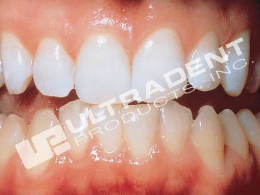 After Whitening