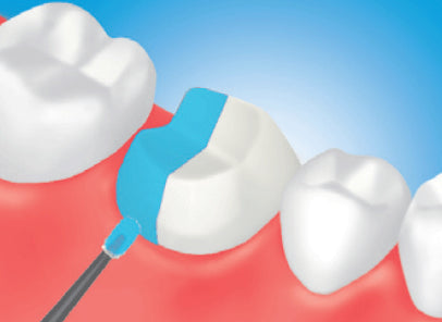 Pretreat the tooth surface