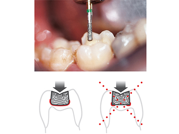 Komet Burs Preventing Micro Cracks in teeth