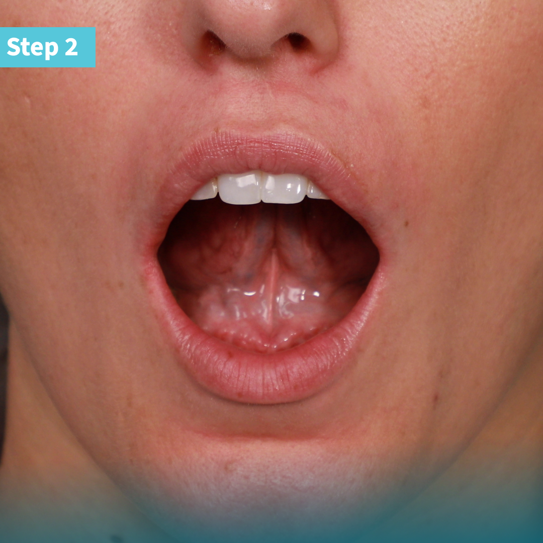 Umbrella cheek retractor clinical technique: step 2 shows a patient with a mouth opened