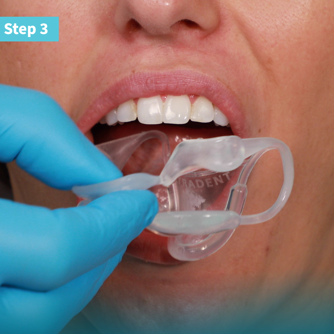 Umbrella cheek retractor clinical technique: step 3 - fold the cheeck retractor and place it in the patient's mouth