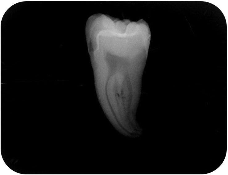 Evanesce Flow Radiograph