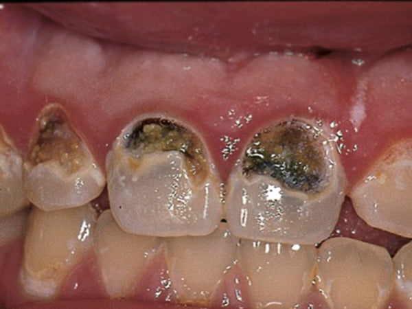 an image of front teeth with black caries