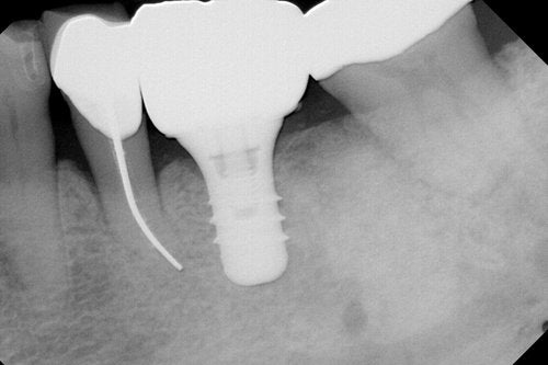 ContacEZ Restorative Strip Crown X-Ray Clinical