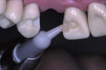 Ribbond Clinical Teeth Preparation