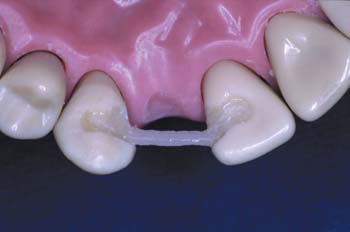 Ribbond Clinical Cover Composite