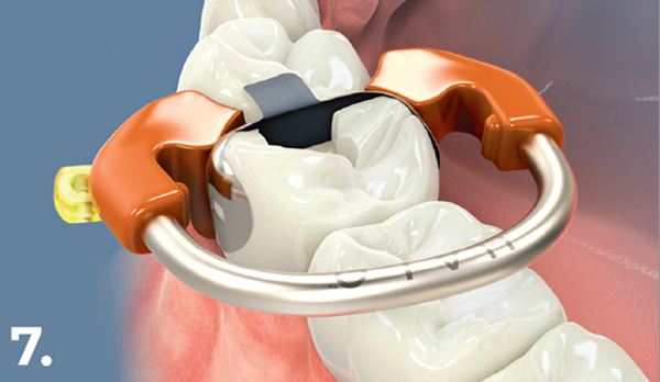 Inspect matrix band, wedge, and ring placement graphic