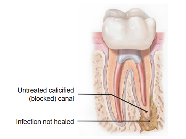 an image of a tooth with untreated calcified (blocked) canal and not healed infection