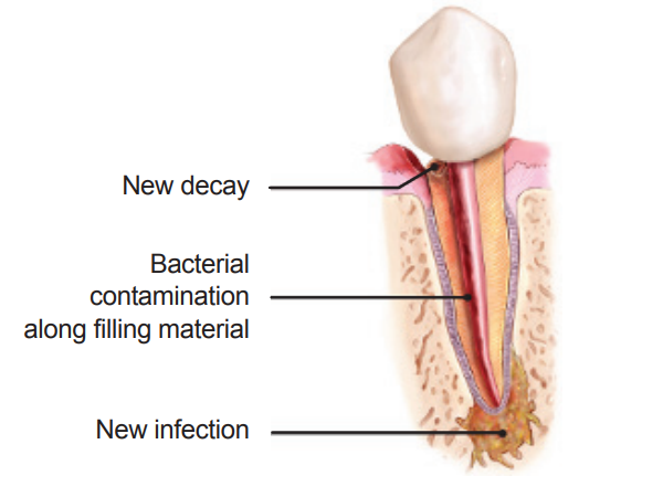 an image of a tooth with the bacterial contamination along filling material