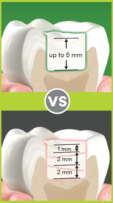 less stress on the tooth