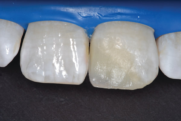 dentin replication on a tooth