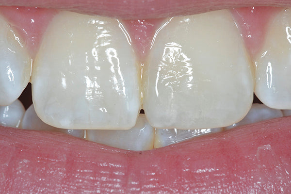 microfill composite on tooth