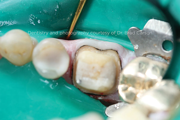 First String Placement Occlusal View