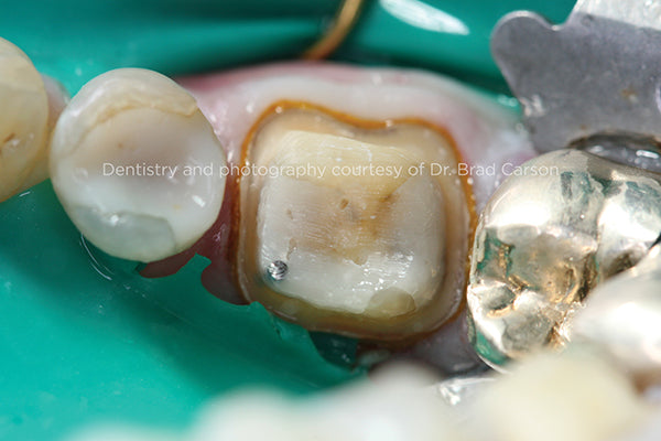 Pre-Impression Occlusal View