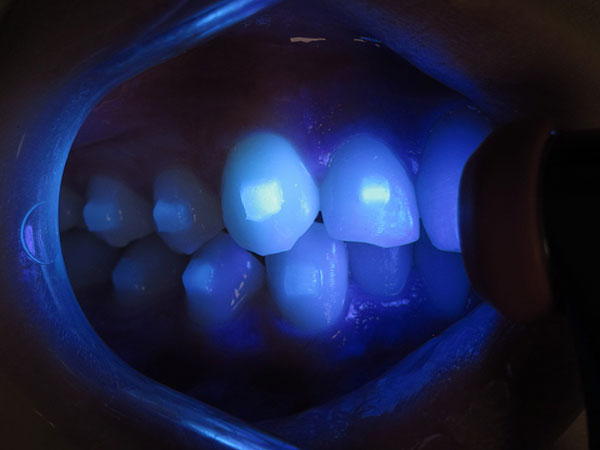 Trans Ice has a fluorescent property for easy removal of flash and for checking voids in the tray.