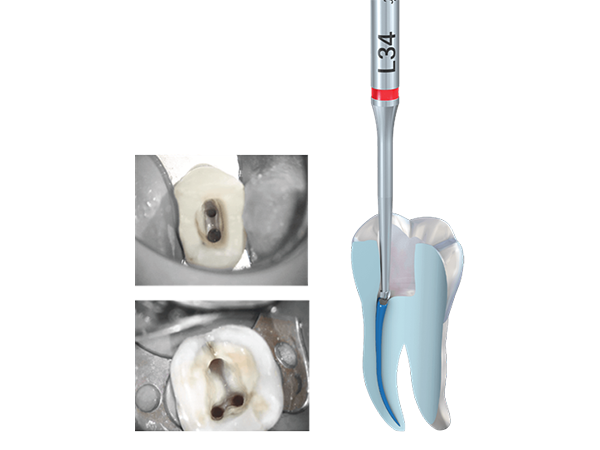 Dental EndoTracer accurate retrieval