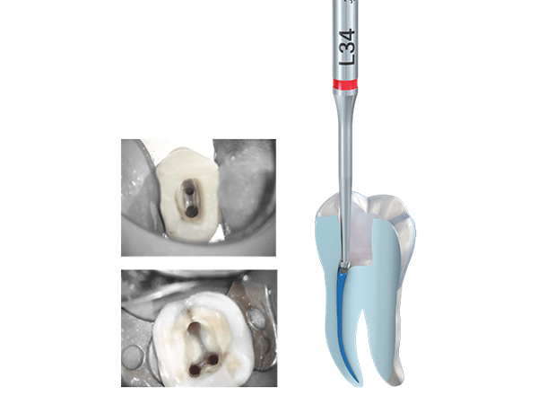 Récupération précise du Dental EndoTracer