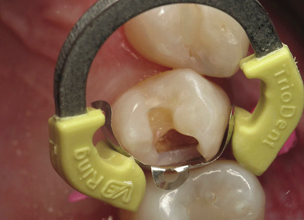 Bande de matrice clinique Triodent V3 Ring