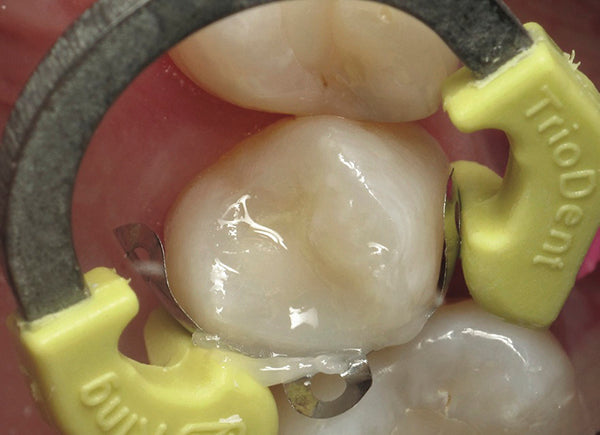 V3 Tab-Matrix Clinical Composite Placement