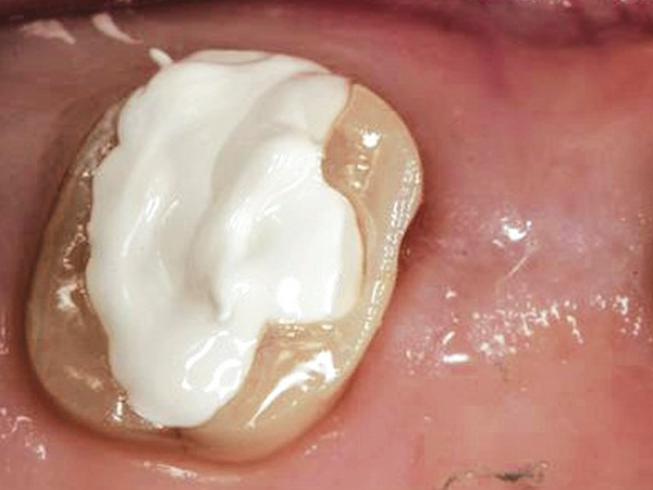 Zircules flows posterior tooth won't slump