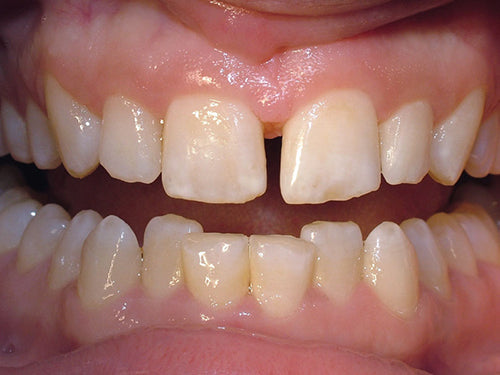 Affinity Crystal Clinical Technique 1: Two mottled centrals with a diastema to be treated with porcelain veneers. Length of #8 to be increased with electrosurgery.