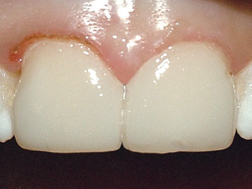 Affinity Crystal Clinical Technique 11: Final temporary veneers.