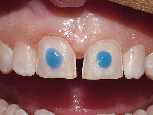 Affinity Crystal Clinical Technique 6: Spot etch preps for retention. If there are more than two preps, spot etch alternate teeth.