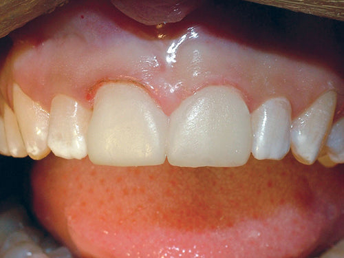 Affinity Crystal Clinical Technique 9: Temporary veneers shown with excess flash peeled off.