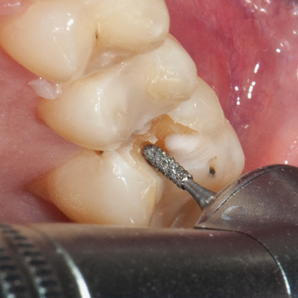 a clinical image of filling removal with 4COMP diamond bur