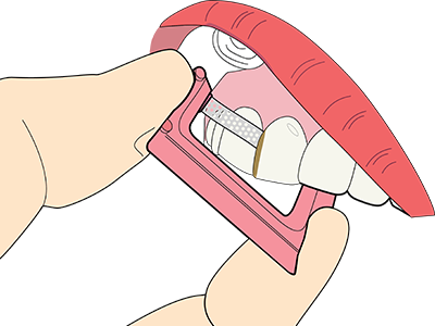 ContacEZ Hygienist Pink Strip Clinical Technique 1