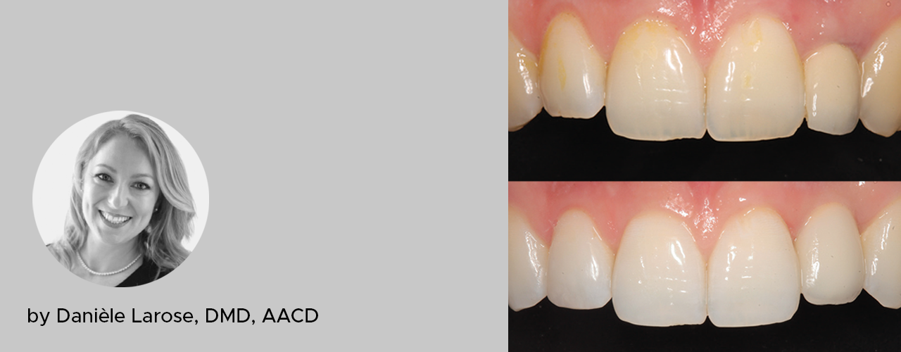 before-and-after-restoration-teeth-with-grey-background
