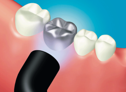 metal crown cementation