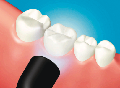 composite resin crown cementation