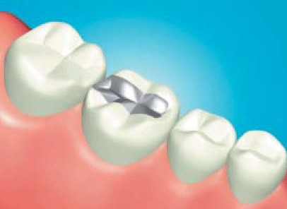 amalgam bonding