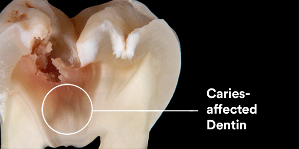 Scotchbond Universal Plus bonds and seals caries-affected dentin