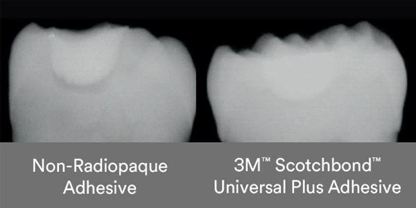 Scotchbond Universal Plus added radiopacity