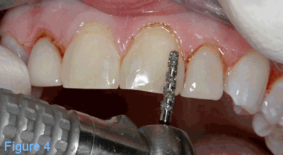 Bulk reduction of the restorations is achieved using the T5856.314.018 bur, leaving a smooth, clean preparation.