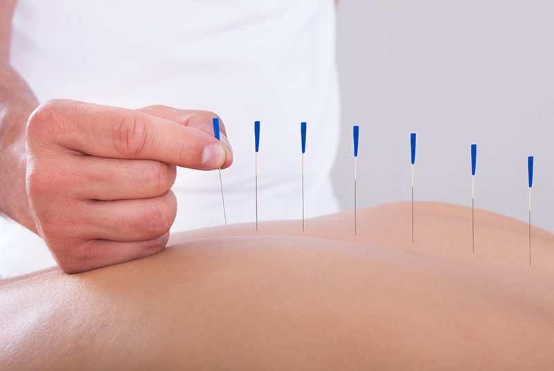 Acupuncture Aiguilles Dos Acupression