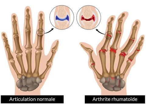 Effets de l'arthrite sur les doigts