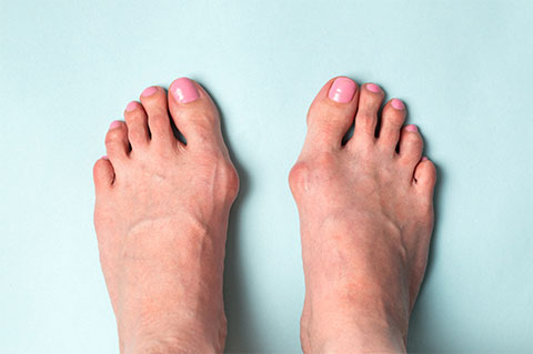 Hallux Valgus