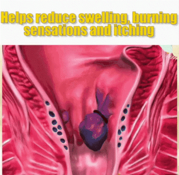 Chinese Herbal Hemorrhoids Treatment Cream