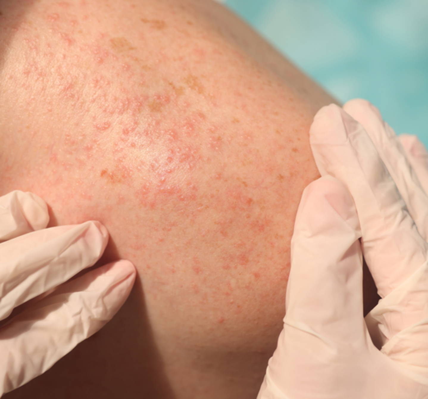 Got heat rash? Here's how to identify and treat the condition - Etre Vous