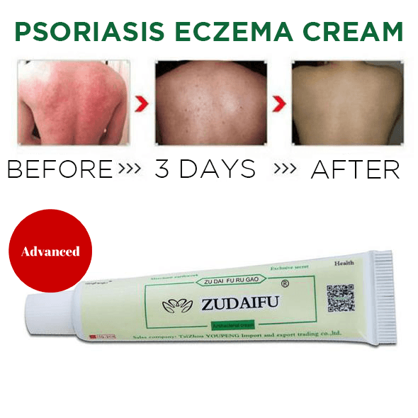 cream for psoriasis on legs)
