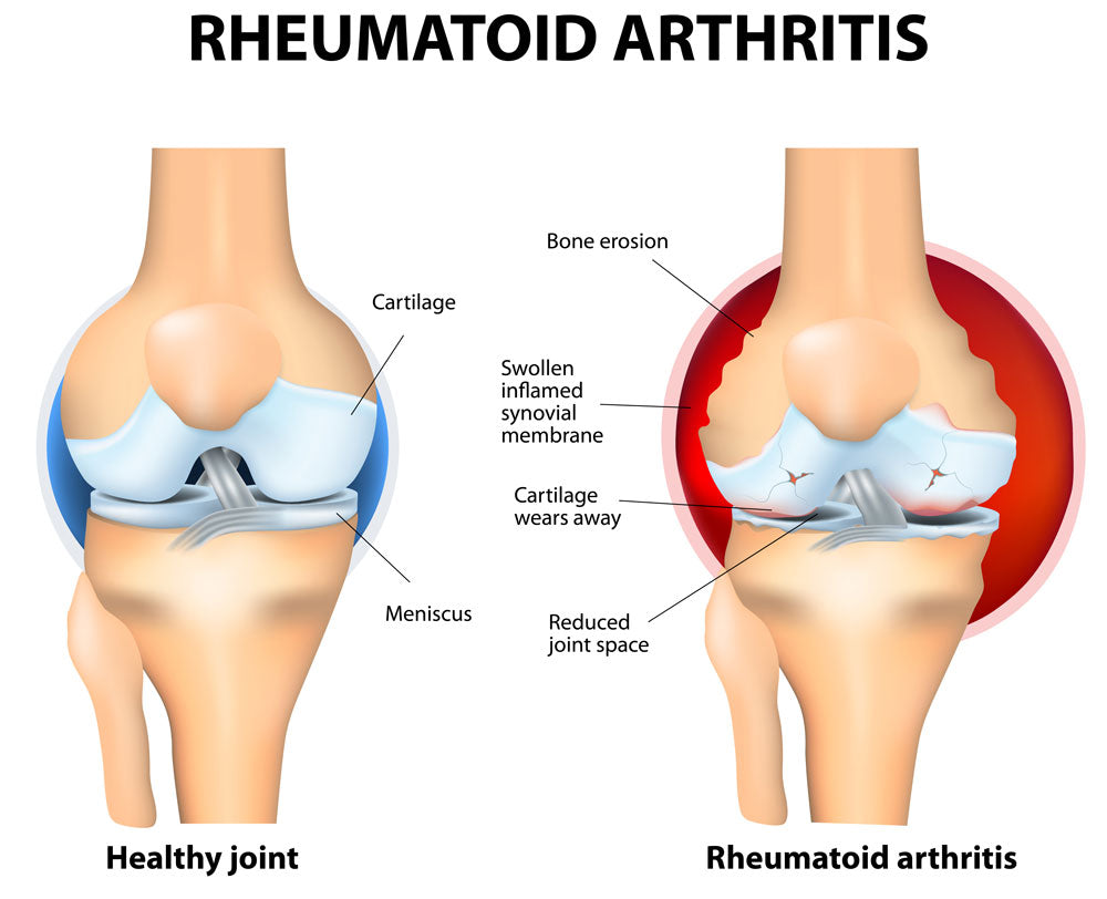 Rheumatoid arthritis