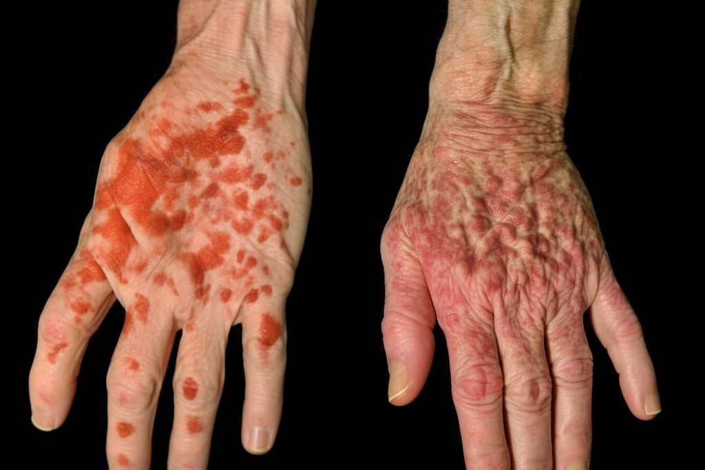 A side-by-side comparison of two hands, each with different skin conditions: red, scaly patches on one hand; dry, flaky patches on the other.